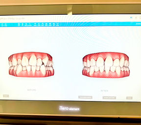 光学式口腔内スキャナー（3Dスキャニング機器）のiTero elementを導入しました。口腔内を3Dスキャンし、歯並びや噛み合わせをその場で確認して矯正後の歯並びシュミレーションが可能です。