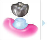 保険診療では、  どうしても治療に使える材料や治療法、  時間が限られてしまいます。 そのため人によっては  満足のいく見た目に  仕上がらない場合もございます。 自由診療での治療もできますので  ご相談ください。  （以下の治療は保険の適用はできません）