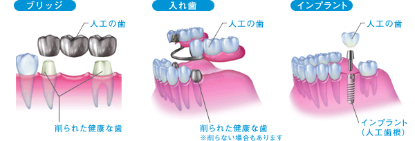 インプラント(人工歯根)は、入れ歯やブリッジにかわり、機能と審美を兼ね備えた治療法です。 歯が抜けた部分に「インプラント」と呼ばれる。 人工歯根を埋め込み、その上から人工歯を装着することで歯の噛む機能を回復させます。